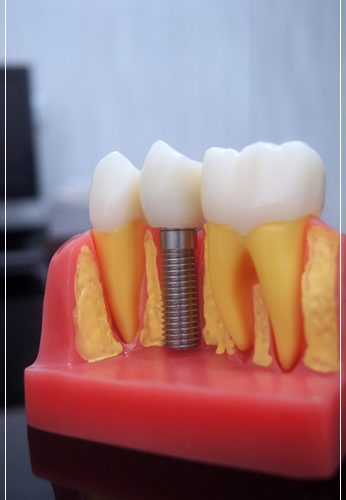 【中部微創植牙】植牙前必須知道的重要事情-我的【植牙】實記，就在台中牙醫做植牙重建！