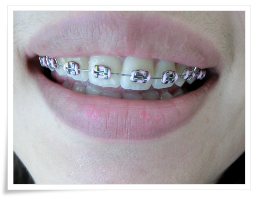 【高雄牙醫權威】高雄牙醫診所的牙齒矯正可以分期唷~牙醫師也相當專業!果然是高雄牙齒矯正超推薦的牙醫診所!