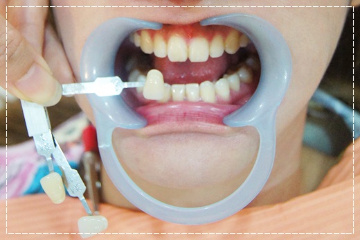 【牙齒美白】高雄牙醫診所做冷光牙齒美白推薦分享,價格比較公道~醫師細心又專業~評價超好的呢!