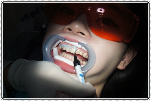 【高雄】冷光牙齒美白介紹分享※高雄牙醫診所的牙齒冷光美白好多推薦~不只評價好價格我更是滿意!