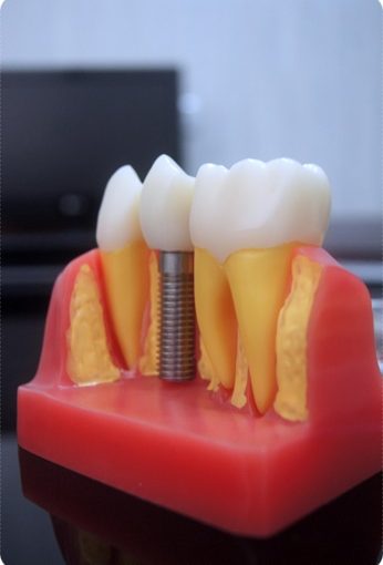 【台南牙科推薦】比較台南牙科診所牙醫植牙技術推薦～看了評論分享牙醫資訊，完整的諮詢和說明是我決定進行植牙的關鍵。