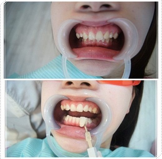 【台南】冷光牙齒美白介紹分享※台南牙醫診所的牙齒冷光美白好多推薦~不只評價好價格我更是滿意!