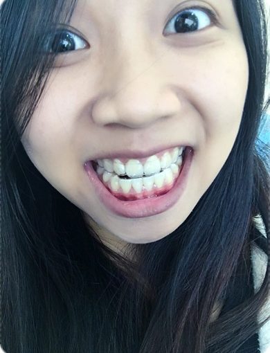 【牙科矯正費用】台南牙科診所的牙齒矯正權威分享!找牙齒矯正專科裝牙套比較推薦,費用也相當合理呢!