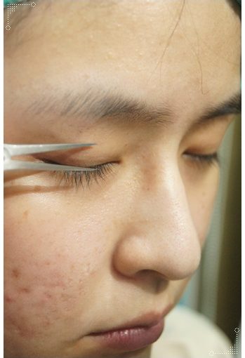 【台北縫雙眼皮】推薦台北整形外科診所的韓式釘書針雙眼皮,整個呆呆的眼睛變得超會電眼!