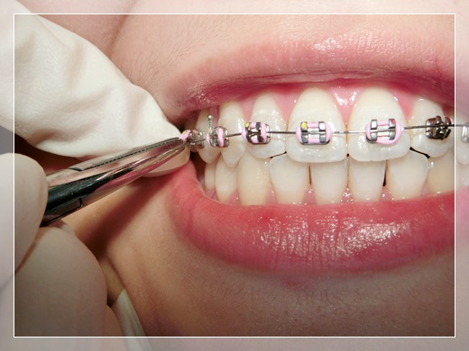 【台中牙齒矯正推薦】裝牙套醫師人超專業超貼心的,推薦到台中牙齒矯正專科裝牙套~~~