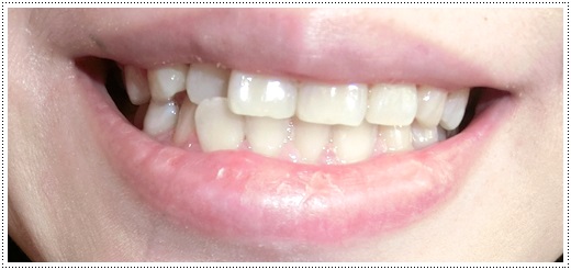 【台灣牙科診所】推薦有很多人分享經驗的台中牙醫診所做冷光美白牙齒，快速又方便，終於有一口白淨的牙齒了！