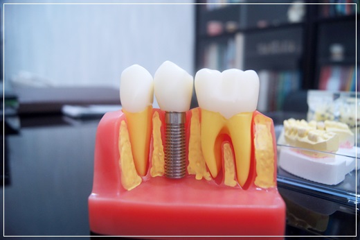 【台北植牙價格】醫師解說詳細而且設備先進的牙醫診所植牙，親友大推薦，讓我恢復健康的牙齒狀態～